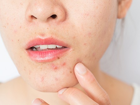 WOW 360|Maskne: What is 'Mask Acne' & How Can You Prevent It?
