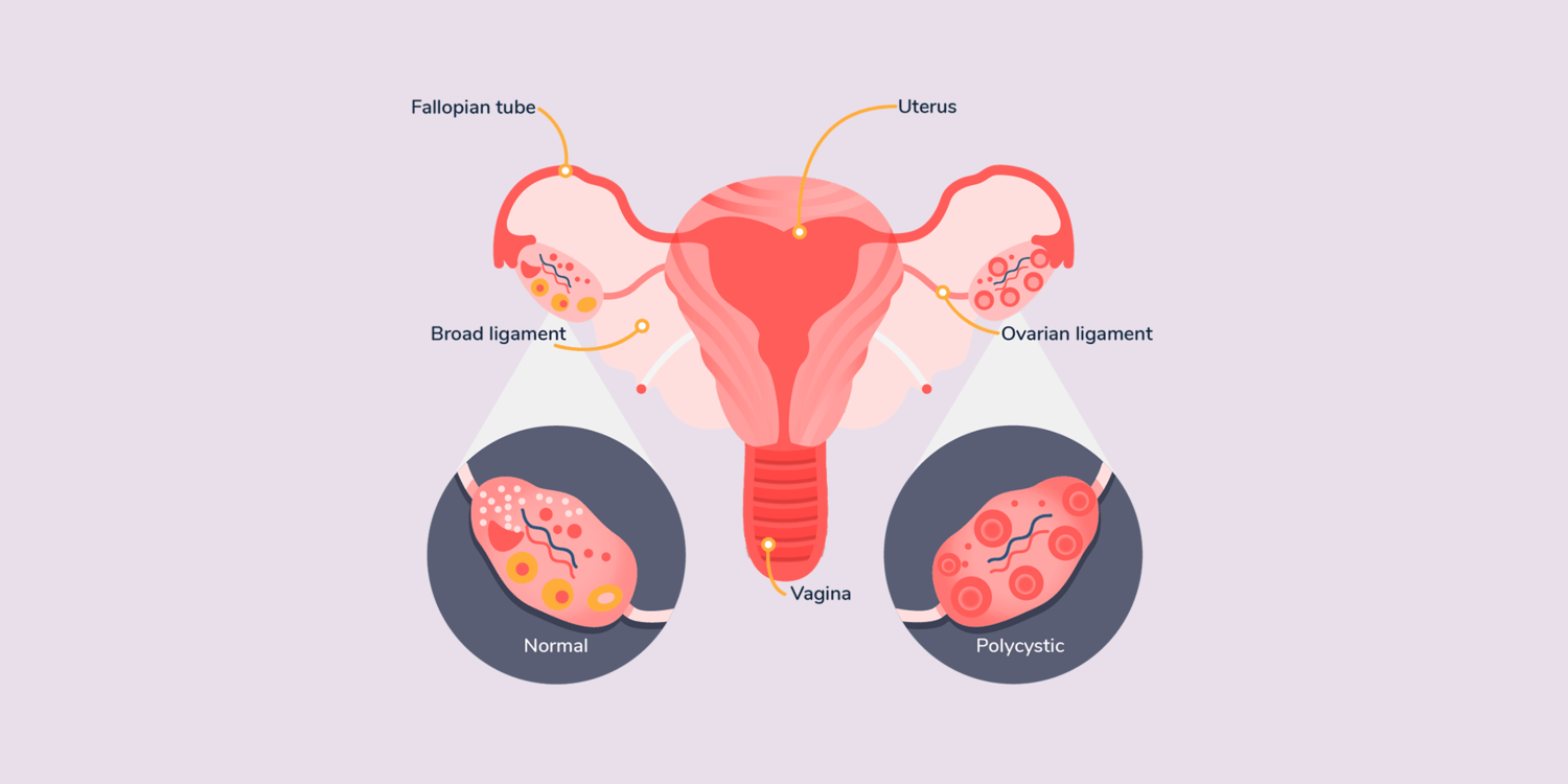 WOW 360|Polycystic Ovary Syndrome (PCOS) in Women: Symptoms, Causes & Myths